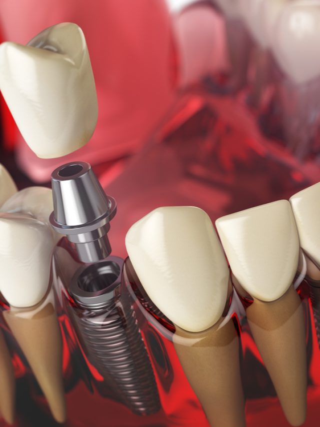 Dental Implants for Missing Teeth in West Hills, California!