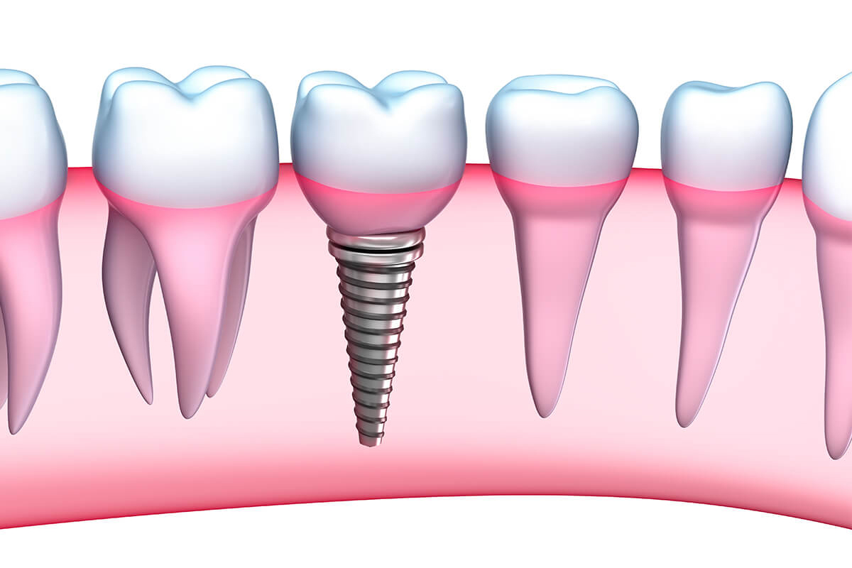 Implants For Seniors in West Hills CA Area