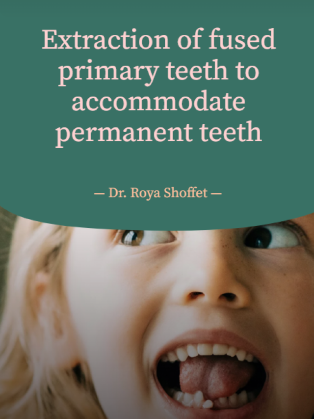 Extraction of fused primary teeth to accommodate permanent teeth