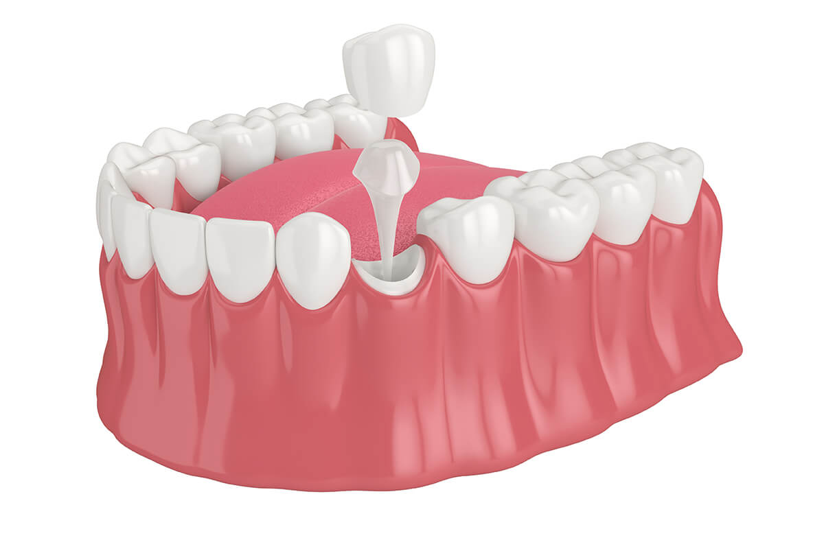 Dental Crowns for Front Teeth in West Hills Los Angeles CA Area