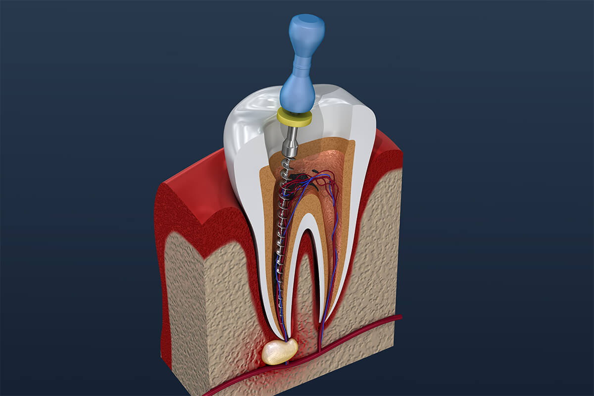 Root Canal Treatment in West Hills Los Angeles CA Area